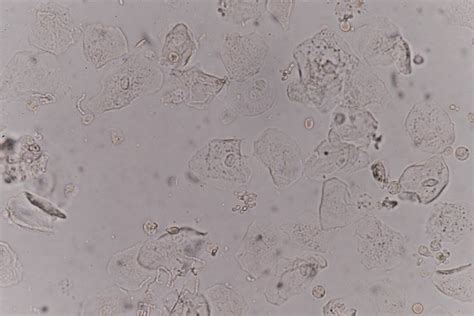 celulas epiteliales en orina
